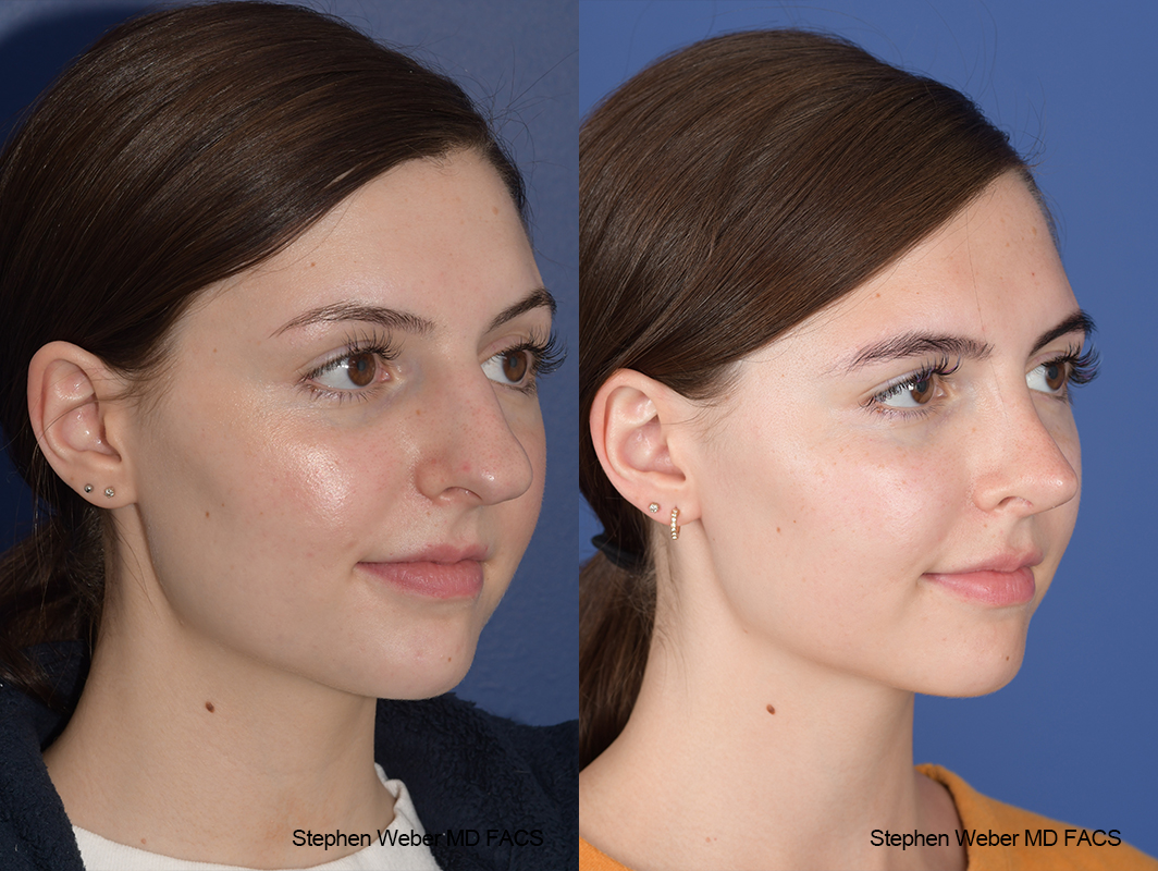 Rhinoplasty Before and After | Weber Facial Plastic Surgery