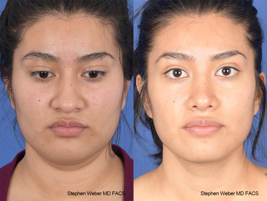 Rhinoplasty Before and After | Weber Facial Plastic Surgery