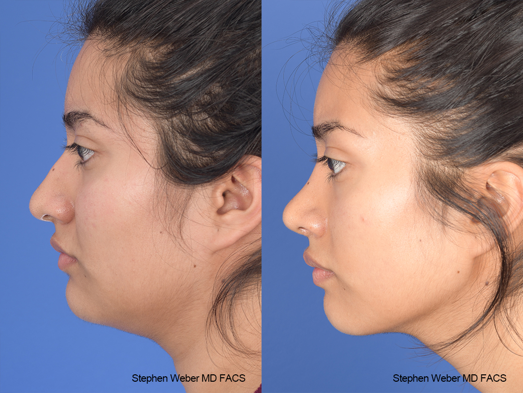 Rhinoplasty Before and After | Weber Facial Plastic Surgery