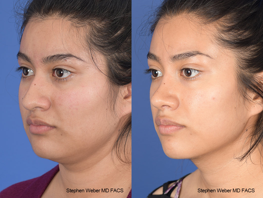 Rhinoplasty Before and After | Weber Facial Plastic Surgery