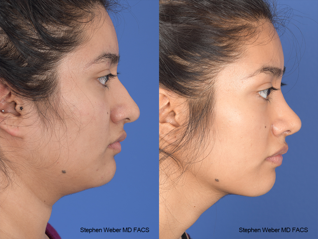 Rhinoplasty Before and After | Weber Facial Plastic Surgery