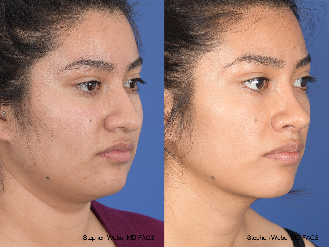 Rhinoplasty Before and After | Weber Facial Plastic Surgery