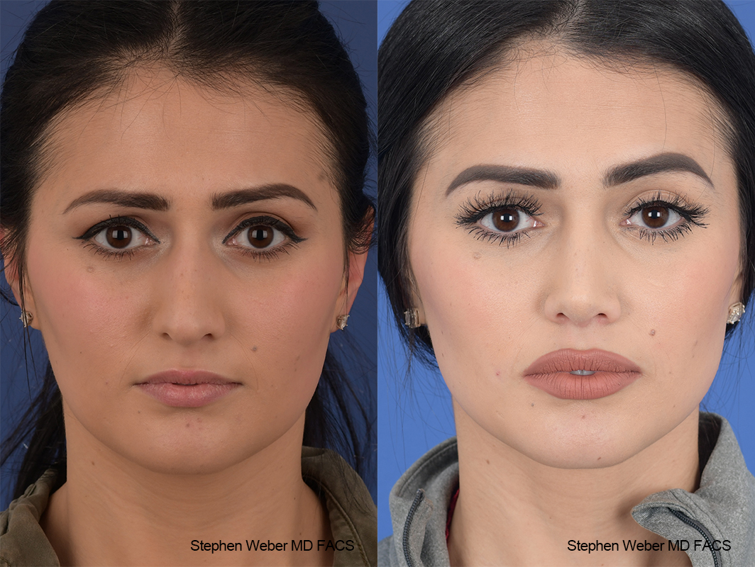 Rhinoplasty Before and After | Weber Facial Plastic Surgery