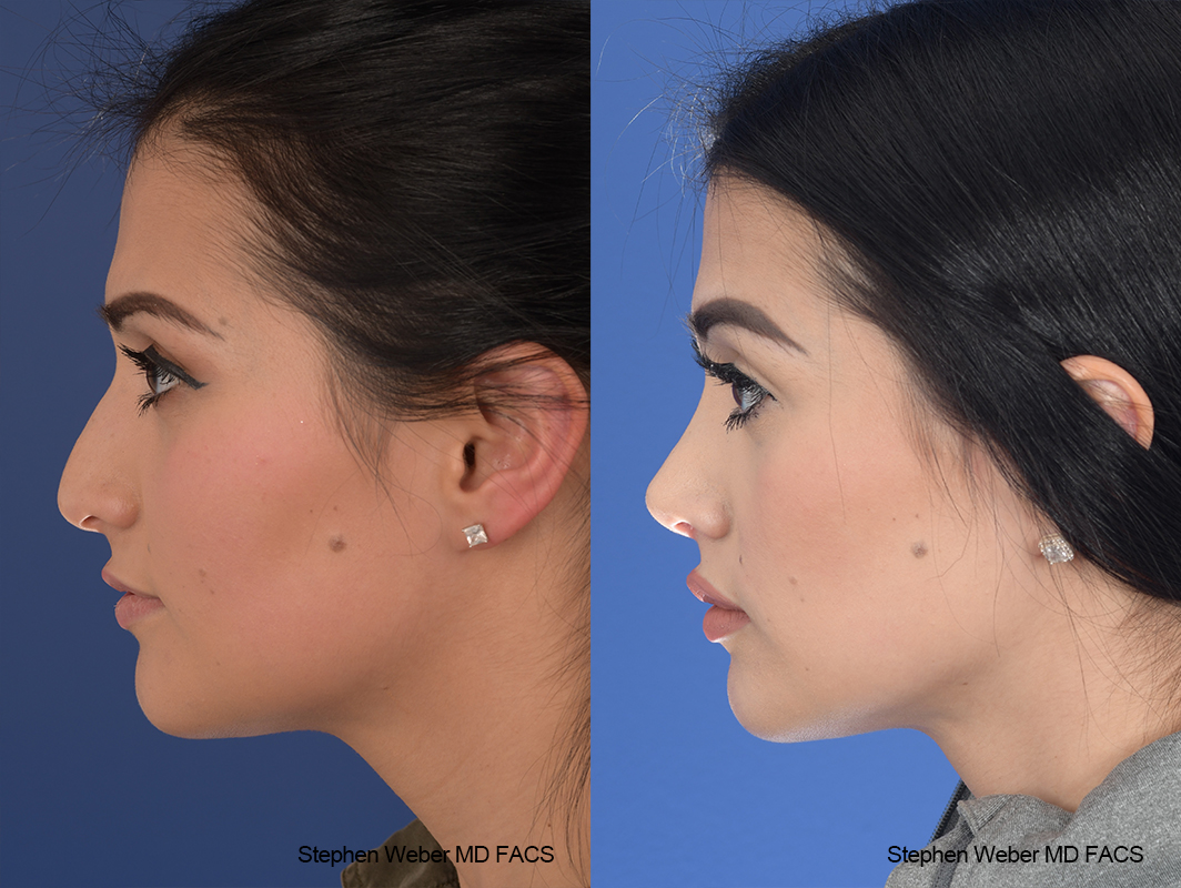 Rhinoplasty Before and After | Weber Facial Plastic Surgery