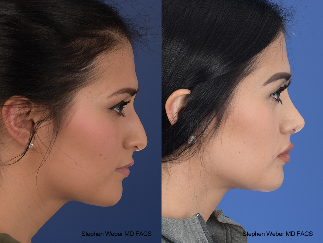 Rhinoplasty Before and After | Weber Facial Plastic Surgery