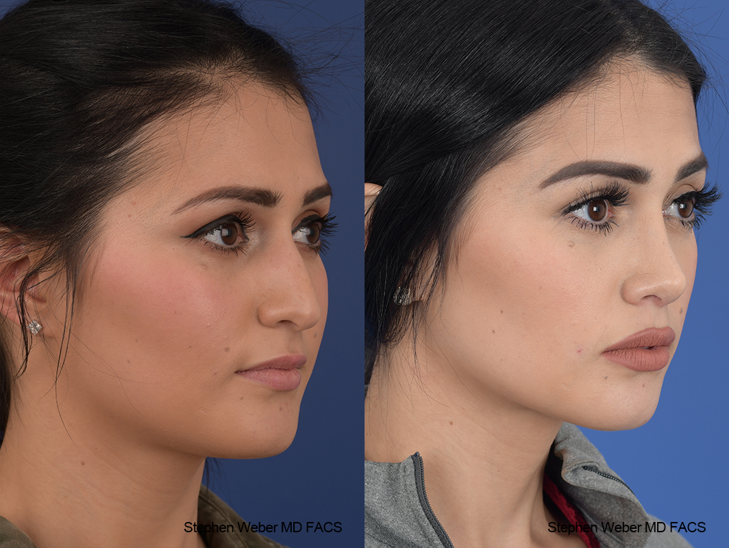 Rhinoplasty Before and After | Weber Facial Plastic Surgery