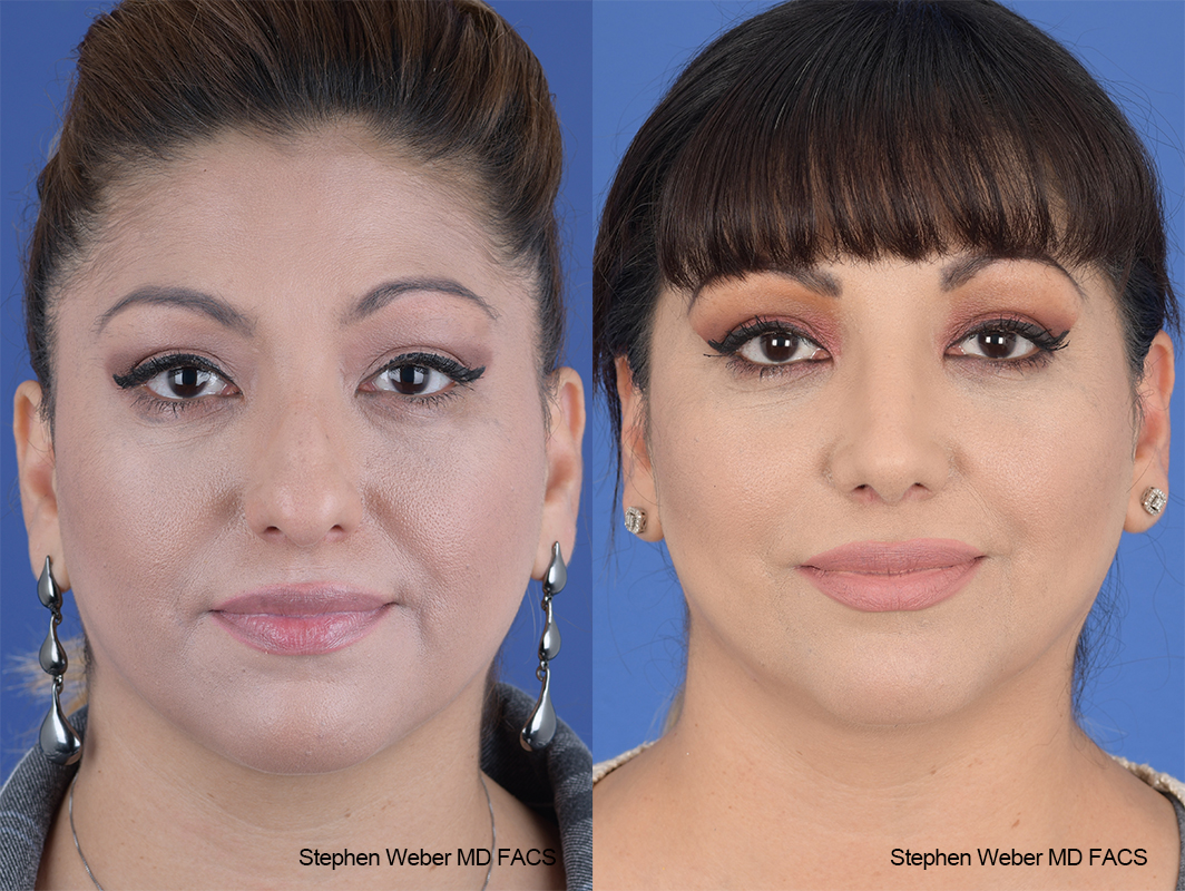 Rhinoplasty Before and After | Weber Facial Plastic Surgery