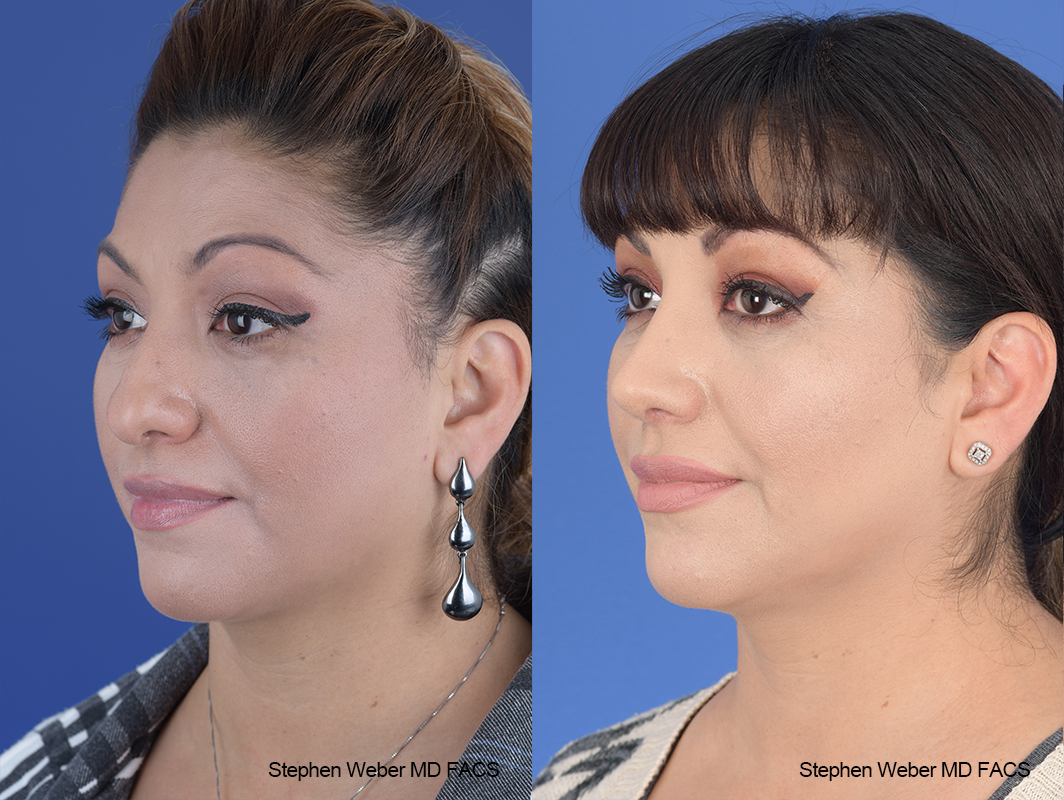 Rhinoplasty Before and After | Weber Facial Plastic Surgery