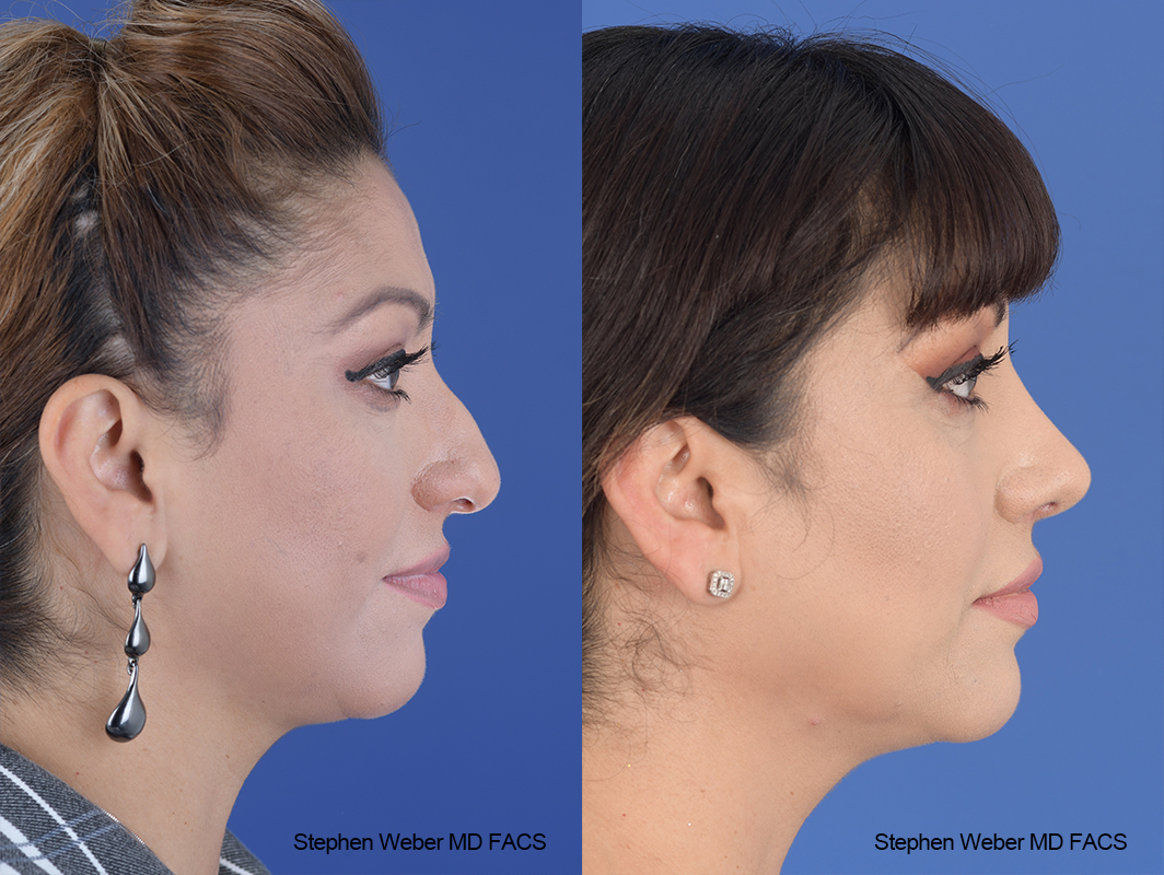 Rhinoplasty Before and After | Weber Facial Plastic Surgery