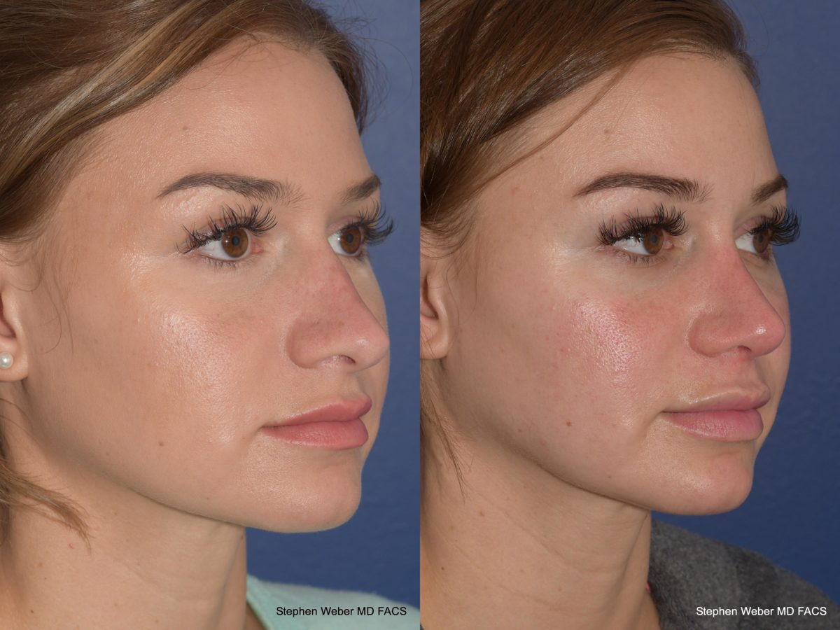 Rhinoplasty Before and After | Weber Facial Plastic Surgery