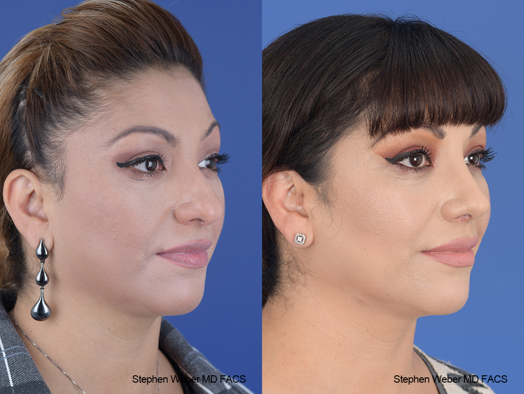 Rhinoplasty Before and After | Weber Facial Plastic Surgery