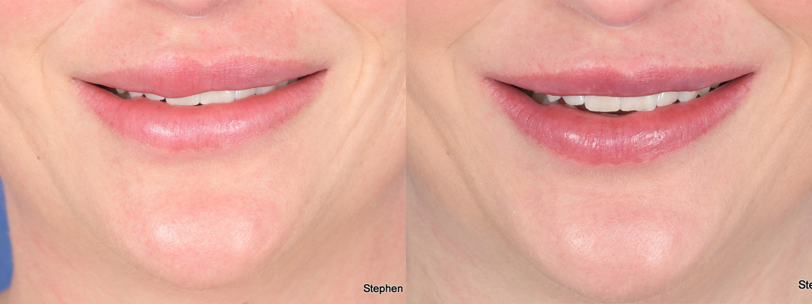 Scar Revision Before and After | Weber Facial Plastic Surgery