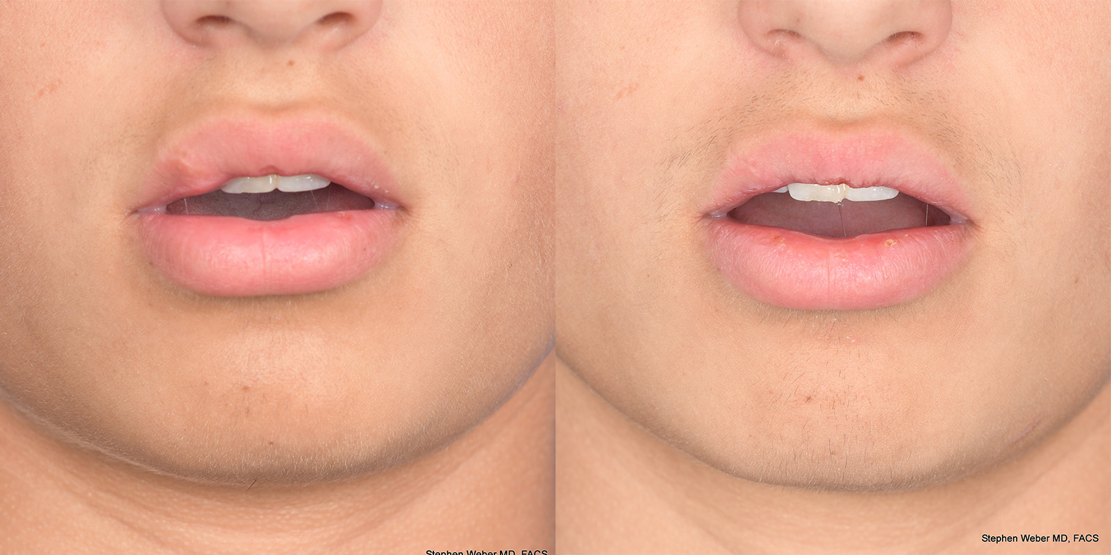 Scar Revision Before and After | Weber Facial Plastic Surgery