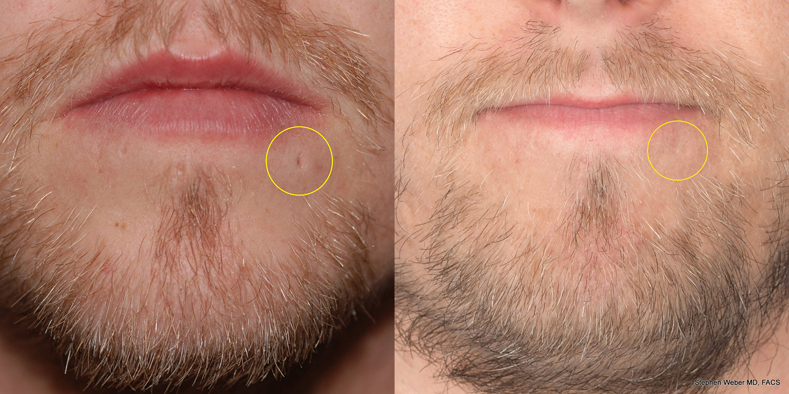 Scar Revision Before and After | Weber Facial Plastic Surgery