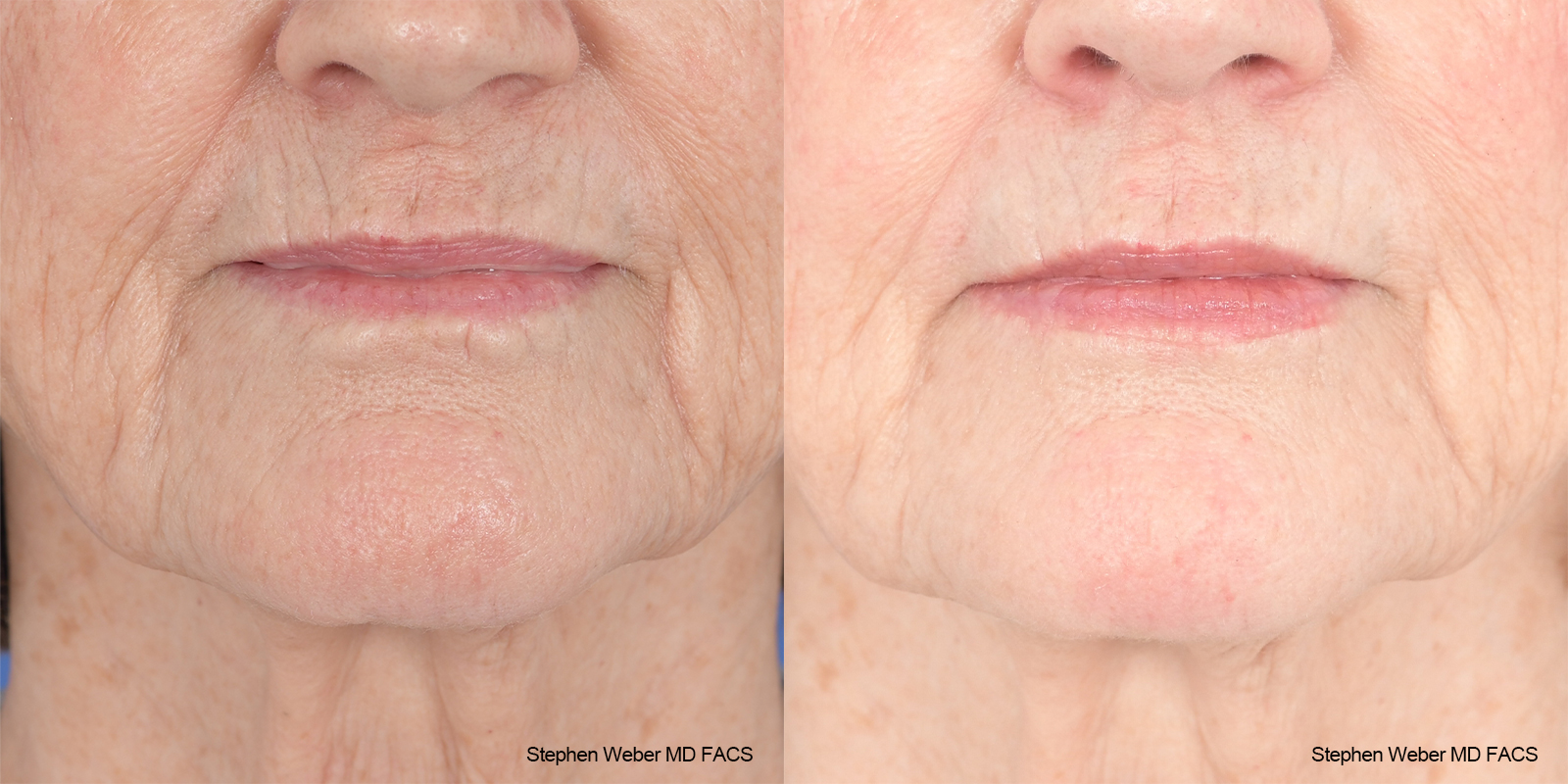 Scar Revision Before and After | Weber Facial Plastic Surgery