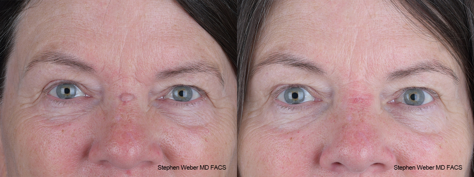 Scar Revision Before and After | Weber Facial Plastic Surgery