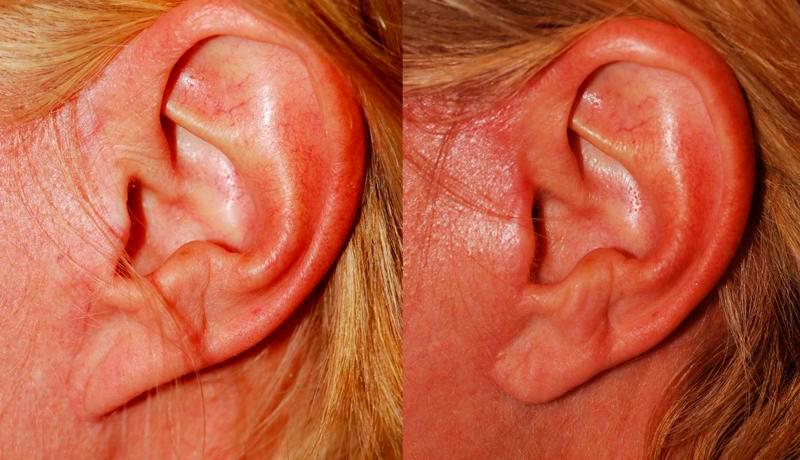 Scar Revision Before and After | Weber Facial Plastic Surgery