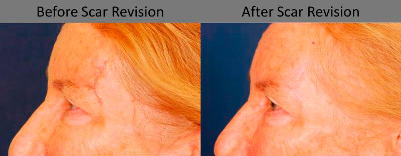 Scar Revision Before and After | Weber Facial Plastic Surgery