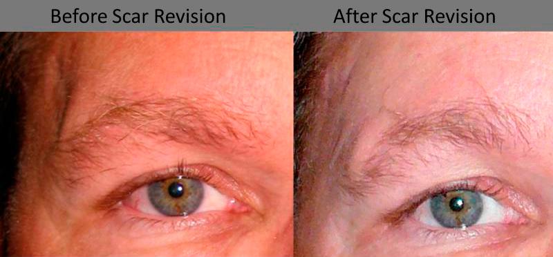 Scar Revision Before and After | Weber Facial Plastic Surgery