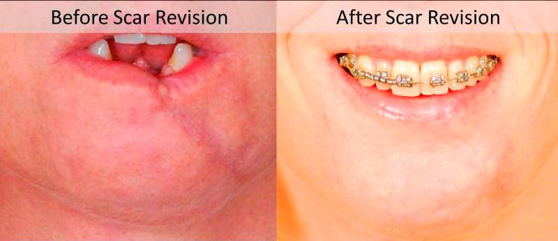 Scar Revision Before and After | Weber Facial Plastic Surgery