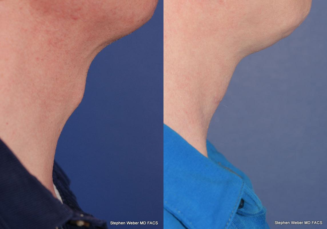 Tracheal Shave Before and After | Weber Facial Plastic Surgery