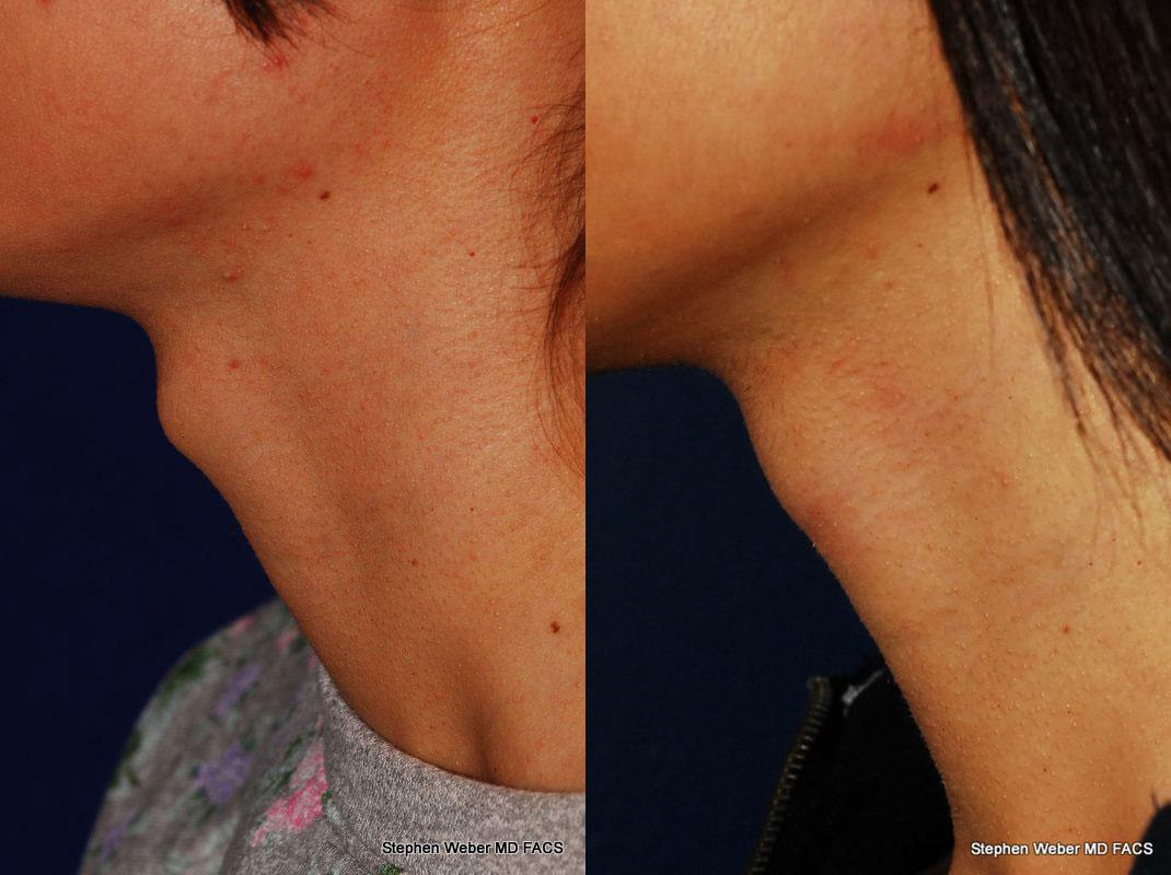 Tracheal Shave Before and After | Weber Facial Plastic Surgery