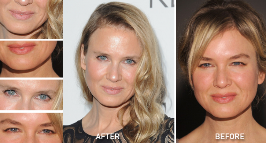 Eyelid Surgery The Woodlands